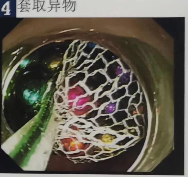 放进|5岁小孩看电视入迷,拿磁力珠放进嘴里,连吞123颗,震惊医生