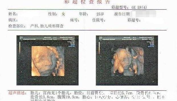 脐带|四维彩超那么贵, 不懂这些就白做了 3分钟让读懂报告单!