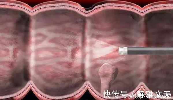 恶性|四部分的息肉，最好及时切除，癌症可能会出现很长一段时间！