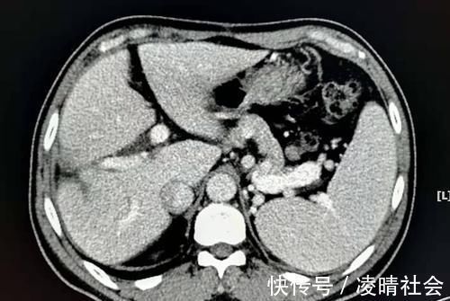 病人|对癌症病人隐瞒病情,是善意的谎言吗?对治疗有帮助吗?