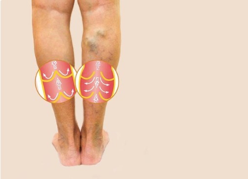 心脑血管|血脂越来越高，皮肤会出现4个变化，早点治疗，莫不放在心上