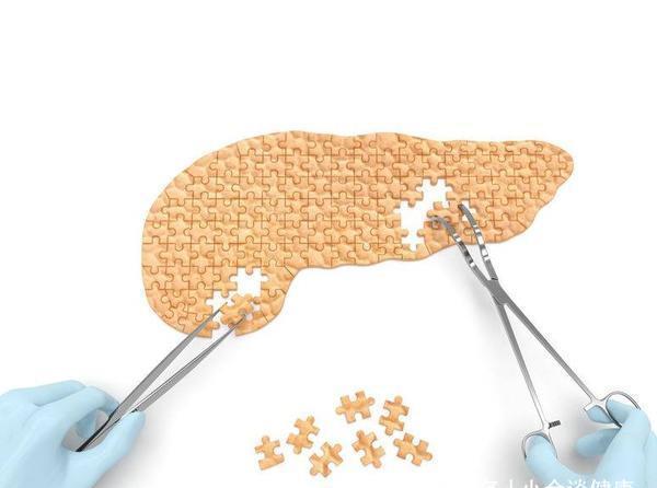 晚期|胰腺癌早期:诊断率不高,3个小症状是“重要信号”