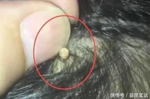 孩子|爸爸给女儿梳头发现“小米粒”,送去就医后,检查结果让他后怕