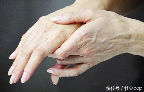 肺栓塞|体内有没有血栓,看看你的手和脚就知道