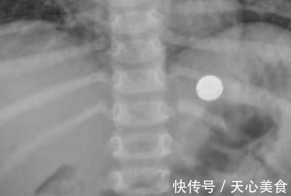 纽扣电池|男童好奇误吞纽扣电池后送医,家长觉得没大碍直接抱回家