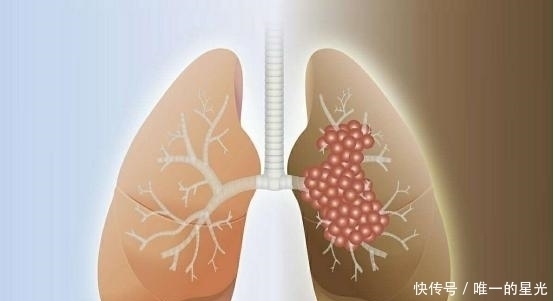 中药|肺癌真的治无可治?中西医综合治疗实现带瘤生存