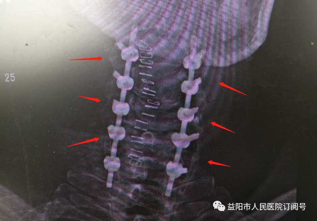 神操作！大娘换膝后第二天就下床行走