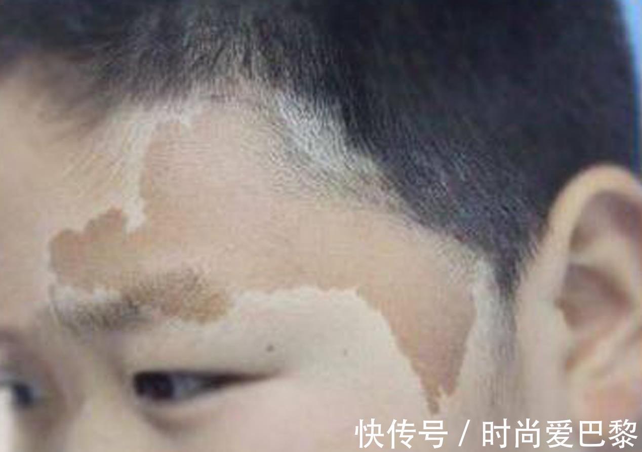 胎记|40%宝宝胎记不是来自遗传,更多是因为孕妈,孕期太放纵四个行为