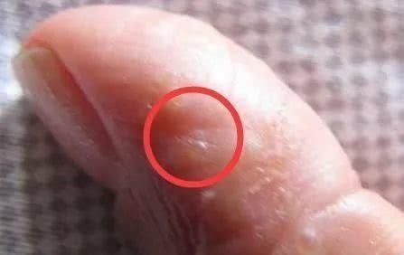 汗疱疹|手上长透明小水泡,还反复发作?其实不是上火,少做3件事摆脱它