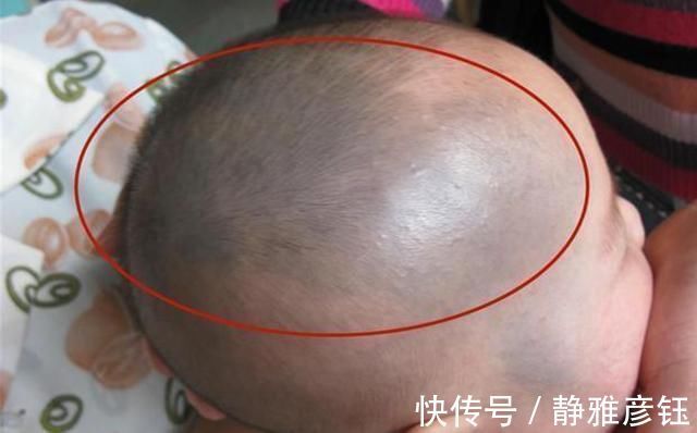 理论|发现新生儿小屁屁上有“淤青”，老公想找护士理论，最后暗暗庆幸