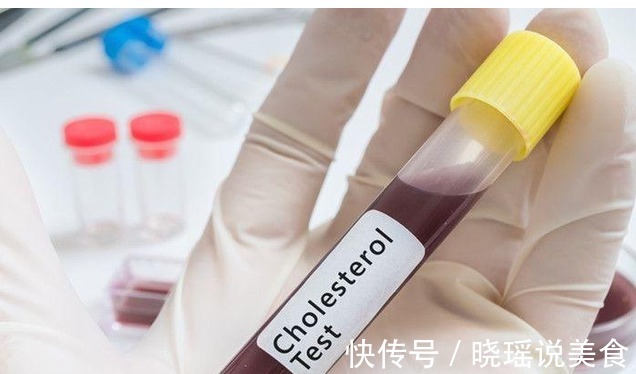 总胆固醇|血脂高,“头”先知若出现这4“异常”,或是“高血脂”入侵