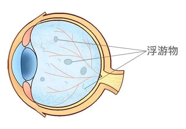 病理性飞蚊症|平湖一女子右眼总能看到诡异“黑影”动个不停！一问专家竟……
