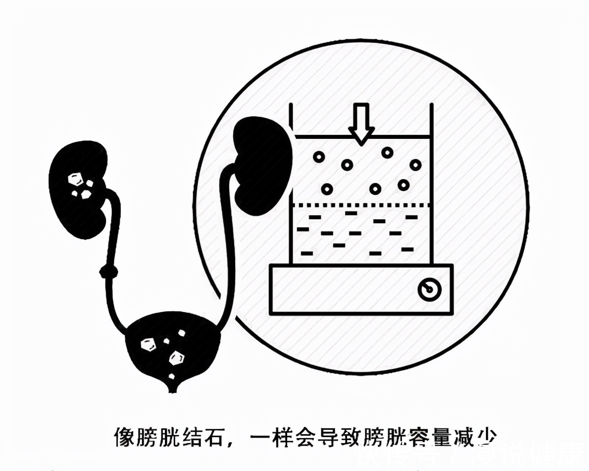 血尿|膀胱有癌,小便先知?如厕时若有这2种迹象,最好排查一下腹部