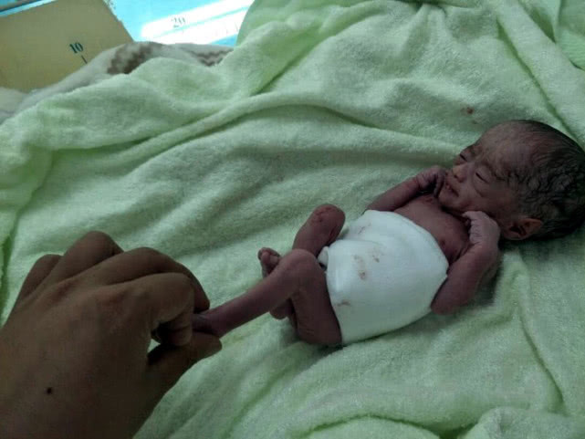 姚甜甜|早产双胞胎姐妹遭遇罕见病,出生时不足两斤,腿还没爸爸手指粗