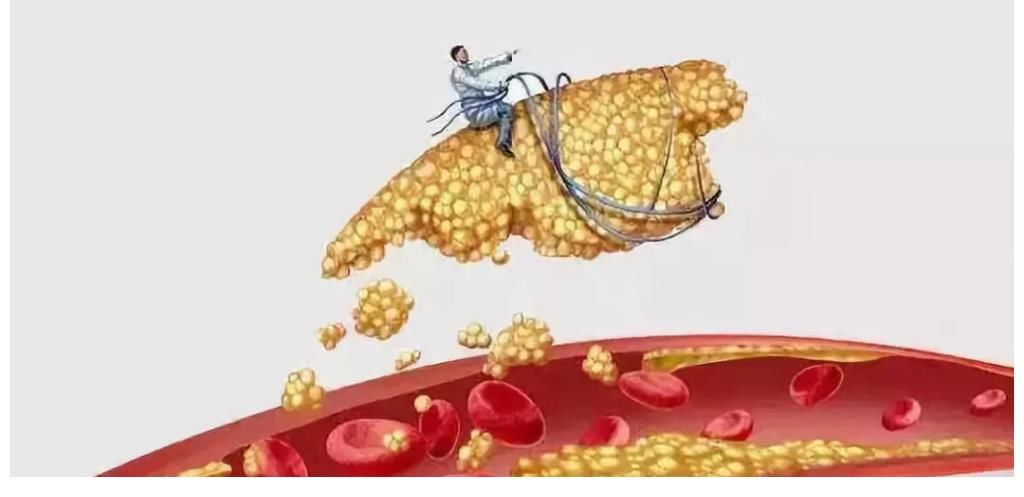 高血脂|血脂升高的信号,1类人群最容易患上高血脂,注意方法,或能降低血脂