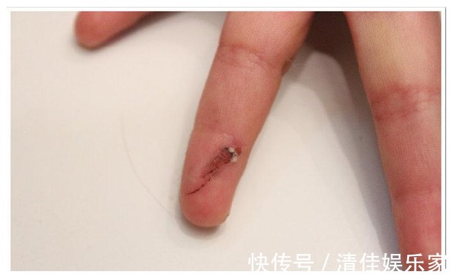 骨骼|89岁院士研究骨疏松60年，提醒3种食物是烂骨王，尽量少吃