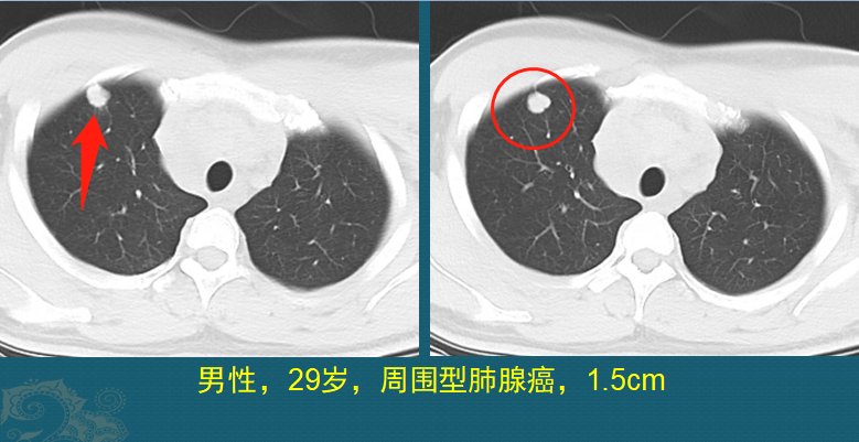 肺鳞癌|肺癌复发和转移的原因是什么？医生用2个病例，指导正确防癌