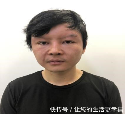法令纹 32岁小伙子拉皮真实记录，术后30天效果很“惊艳”！
