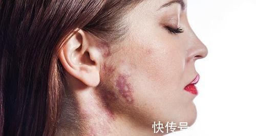 预防肝硬化|身体发现了5个异常变化时,也许是肝硬化的“前兆”,一定要留意