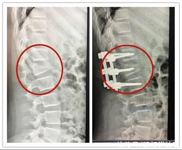 萱萱|4岁孩子一个动作导致高位截瘫！6岁以前别轻易给孩子报这些兴趣班