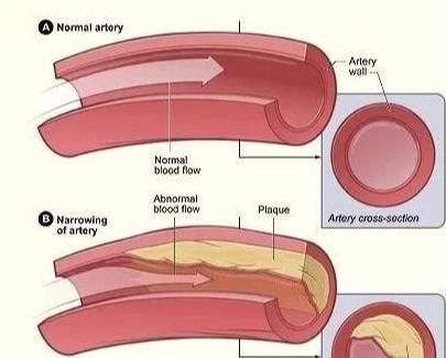 中老年人|终于找到血栓杀手了!50岁以后,不想血管被堵死,常做3件事就