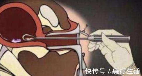 堕胎史|孕妈做“引产”手术，腹中的胎儿会有感觉么看完忍不住心疼