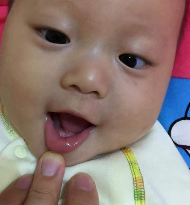 医生|宝宝一出生就有两颗牙齿,宝妈满心欢喜,医生却泼冷水:拔掉吧