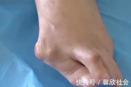 女性 爱穿高跟鞋的女性一定要小心,拇指外翻堪比“裹脚”!不可忽视