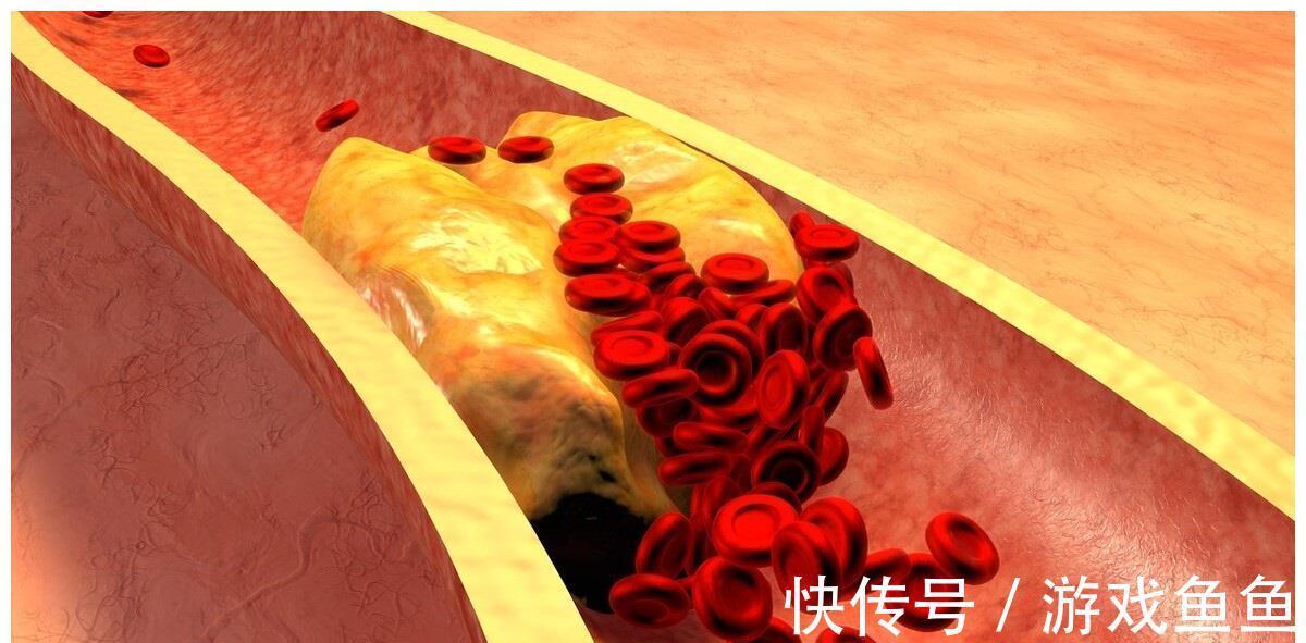 动脉狭窄|如何让动脉狭窄减轻？降低血脂，能使粥样硬化斑块变小吗？