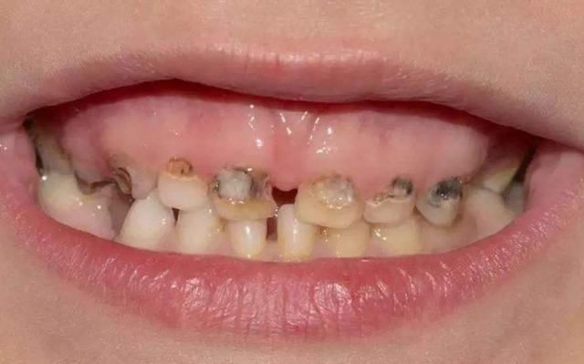 氟氟|让孩子“满嘴烂牙”的不是糖,而是“这1物”,每个人家里都有