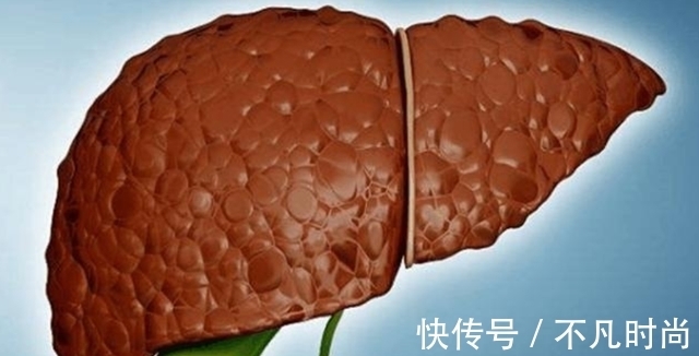 食物|大蒜是肝病的“发物”？医生提醒：若想养肝，这5种食物尽量少碰