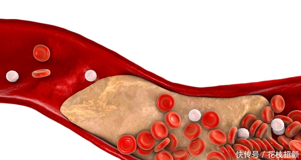 47岁大姐不吃肥肉,确诊脑梗,医生提醒:1种“零食”偷偷堵住血管