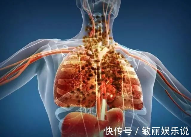 忠告|为什么肺癌越来越多?忠告:少惹三种“气”,头部3个表现要就医