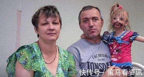 夫妻二人|三岁小女孩患“罕见怪病”,一出生就没有嘴巴,医生建议安乐死