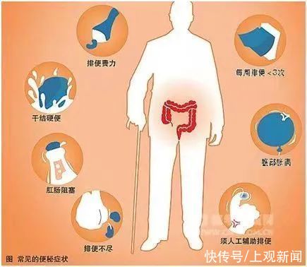 排便|你有没有受便秘折磨？小编带你从“肠”计议……