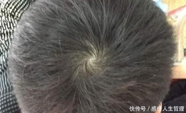 头旋|孩子头上的“旋”的个数,暗示孩子智商高低家长要了解真相