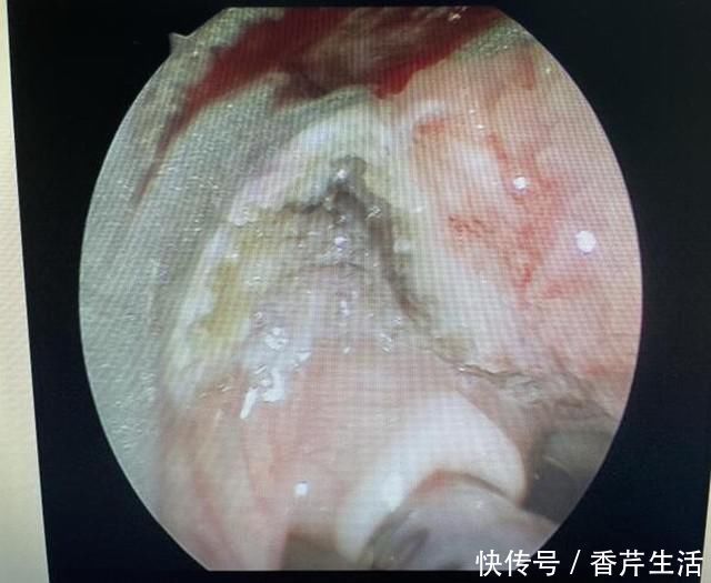 气管|真·如鲠在喉!济一2个月小孩嗓子里长了巨大肿瘤