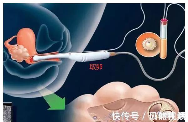 胚胎|取卵多但医生为什么不建议移植鲜胚胎呢