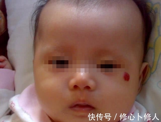 胎记|宝宝眉心有胎记,宝妈却不以为然,12个月宝宝送医抢救无效
