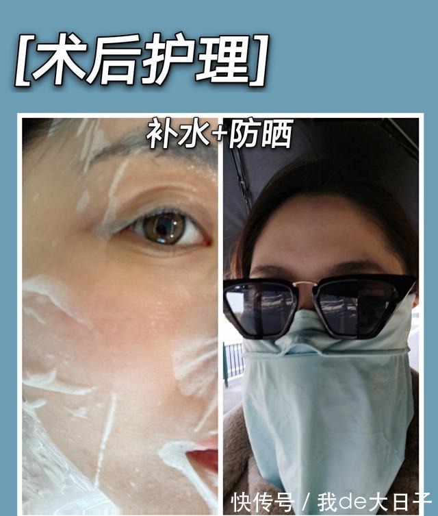 光子嫩肤 6次光子嫩肤后,我的脸怎么样了!