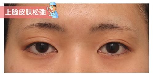 你的眼皮都有几层了?