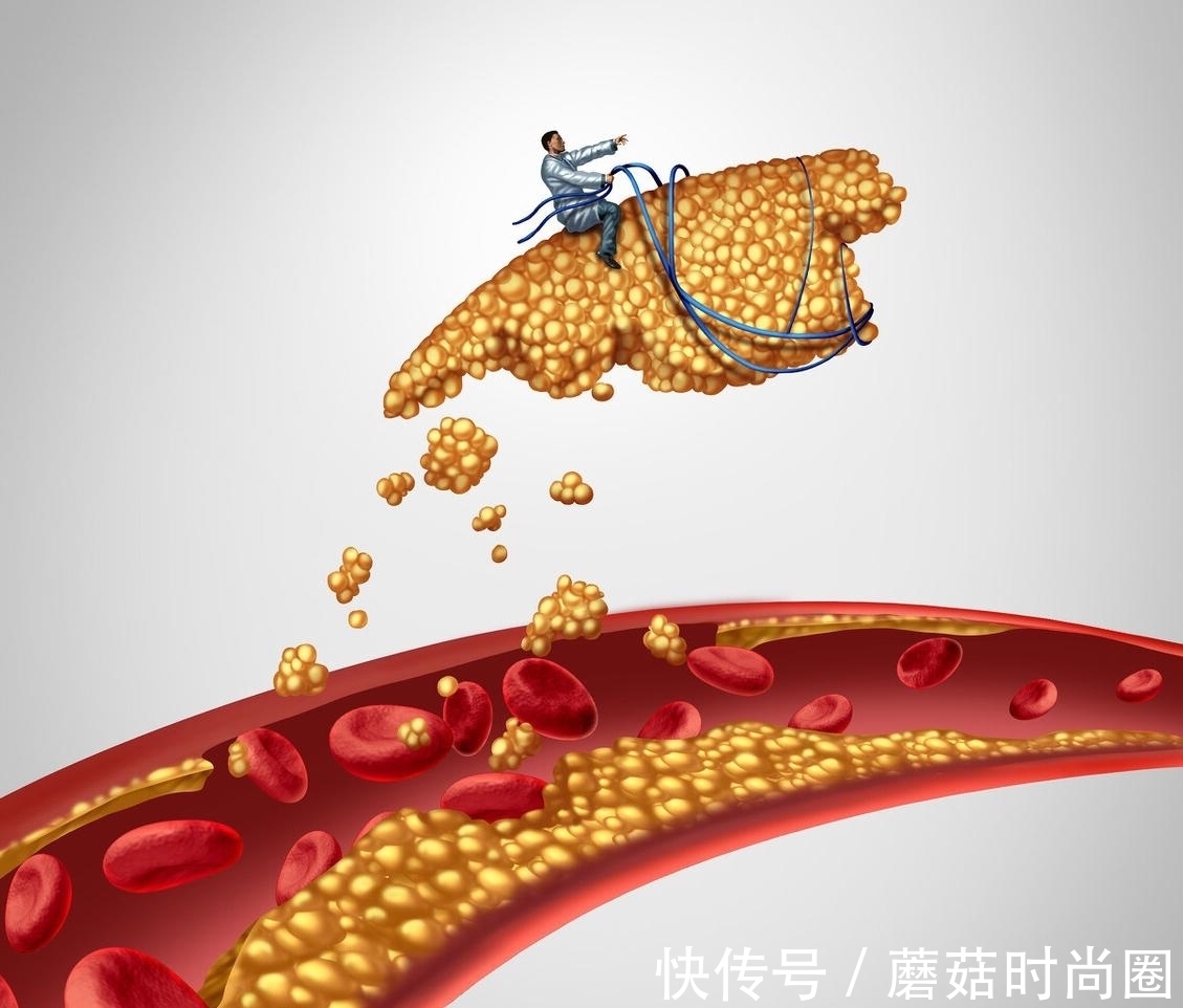 低密度脂蛋白胆固醇|高血脂的“天敌”是什么？本文带你详细了解