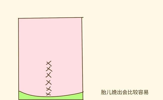 剖宫产中，横切口和竖切口有什么区别？