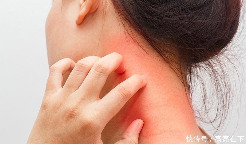 你也是肌肤敏感族？3不做避免成为长期发炎肌！