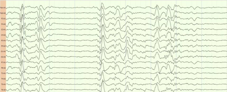 心跳骤停|医生,我爸还能醒吗?会不会变成植物人?