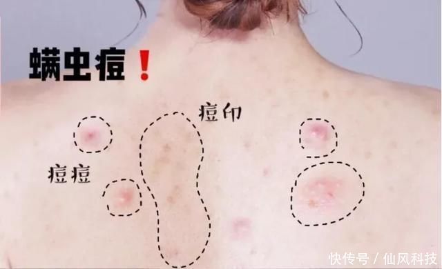 螨虫|90的人都在陪螨虫睡觉螨虫最怕3种东西,好好利用,螨虫跑光光