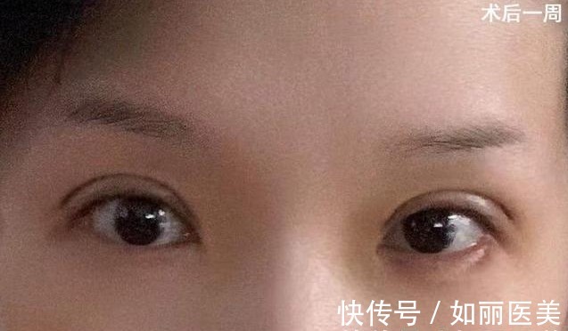 切口 双眼皮越宽眼睛就越大吗?医生揭开双眼皮手术的5个“真相”!