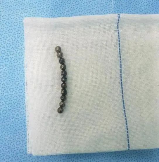 珠江医院|家长注意!三岁男童误吞“夺命玩具”致严重肠穿孔