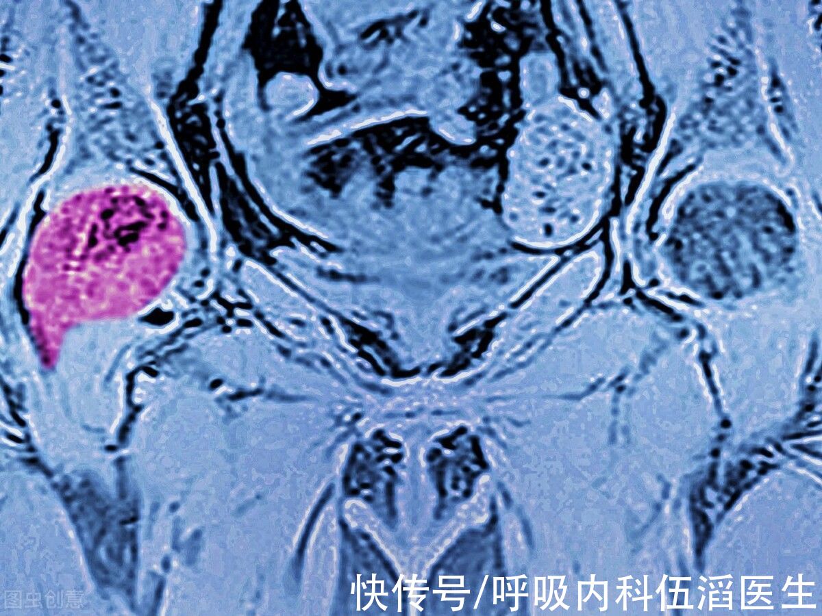 肺癌|36岁姑娘被查出肺腺癌,抗癌之路却鼓舞人心