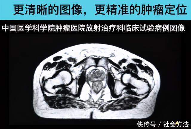 癌症|为什么很多人宁死也不放疗真能治好癌症吗听听专家怎么说